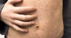 Measles deaths 'staggering and tragic'