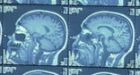 Troops with brain injuries face other possible problems
