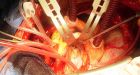 Study supports fixing heart valves without surgery